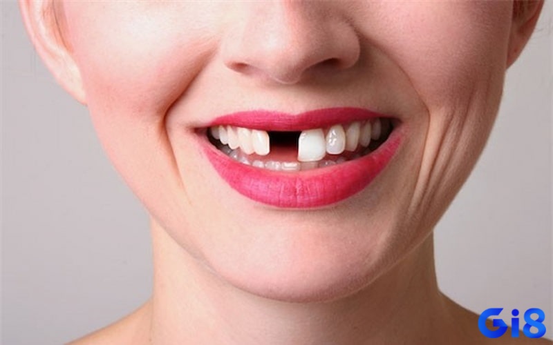 Chiêm bao thấy rụng răng cửa thường báo trước nhiều thách thúc cho đề thủ