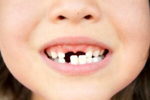 Giải mã giấc mơ bị rụng răng - Ý nghĩa và điềm báo bất ngờ
